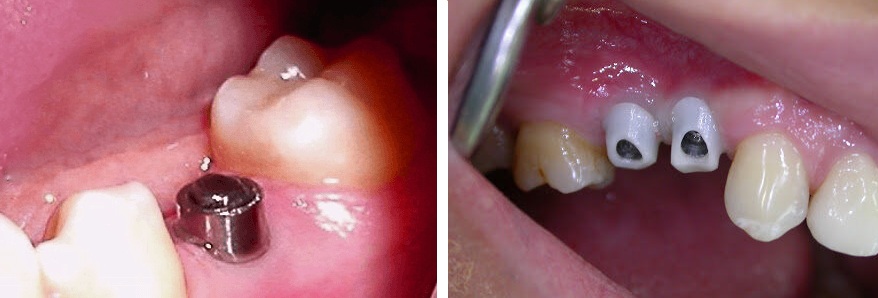 s_implant.jpg
